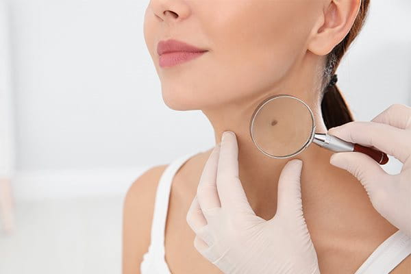 Was Passiert Wenn Man Ein Muttermal Aufkratzt www.de.eucerin.ch